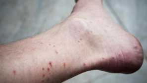 Alergie na bloch bites popis, symptómy, liečba, prevencia