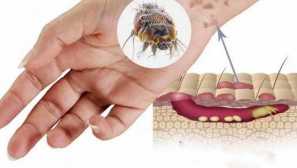 Chesoccal tick popis, príznaky svrabov, liečby a preventívnych akcií