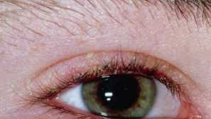 Okeško tight popis, príznaky infekcia, komplikácie, efektívna liečba