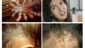 Objednávka 26. Novembra 1998. N 342 o posilňovaní opatrení na prevenciu epidemického sacieho týfusu a boj proti pedikulózovým stránkam. Jeden