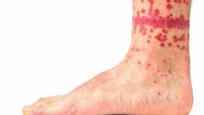 Bloom uštipne, aké parazity sú hryzení ľudí, ako sa uštipne vyzerajú ako nebezpečné pre ľudí!